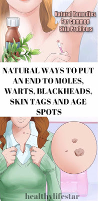 NATURAL WAYS TO PUT AN END TO MOLES, WARTS, BLACKHEADS, SKIN TAGS AND AGE SPOTS