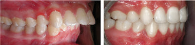 Bọc sứ có thể chỉnh 2 răng cửa bị vẩu