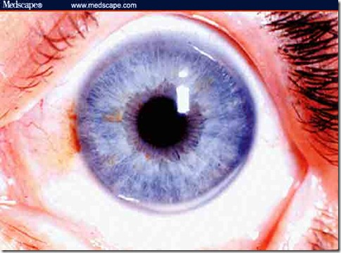 arco corneal