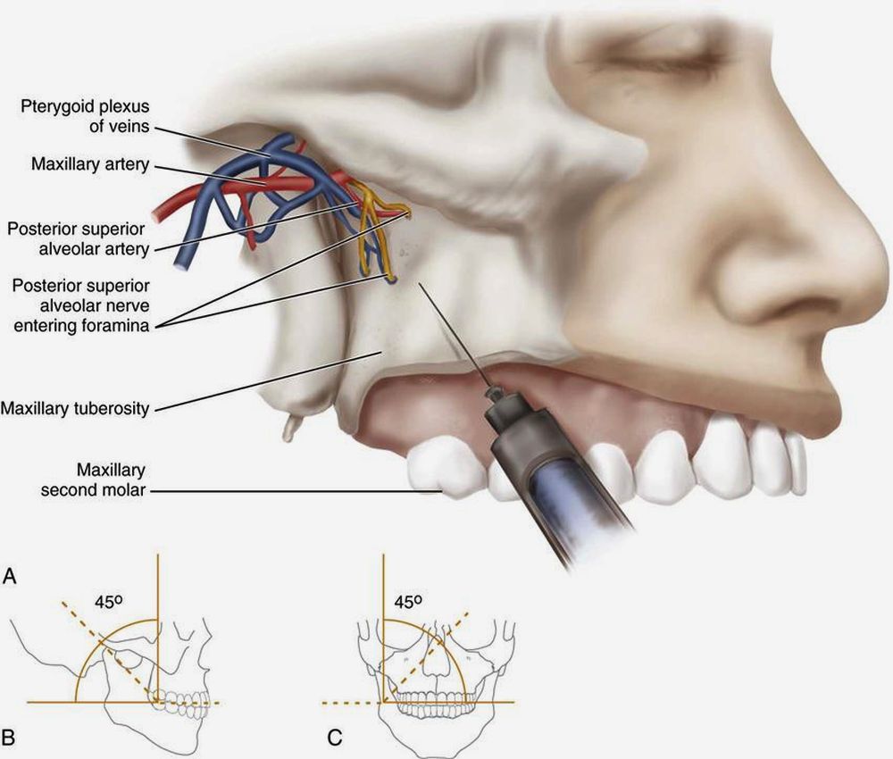 Dental Anesthesia