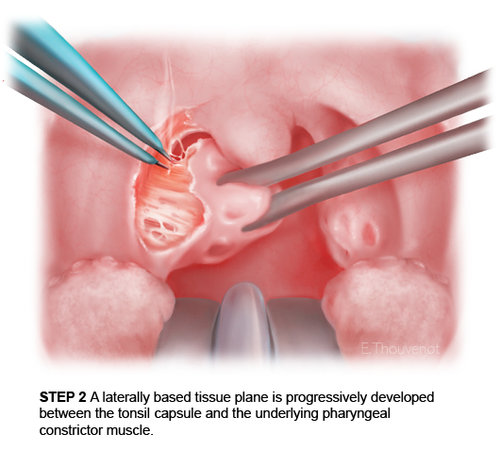 Tonsillectomy steps