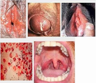 Macam2 obat gonore (kencing nanah), apakah obat sipilis, sifilis pada wanita pdf, obat sipilis paling ampuh, penyakit gonore di mulut