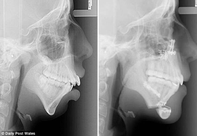 Rx mandibula y dentadura