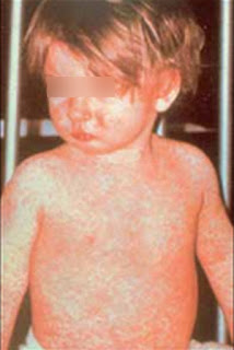 Brown rashes all over the body caused due to the regular measles rash disease pictures