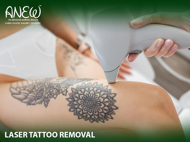 laser tattoo removal in bangalore