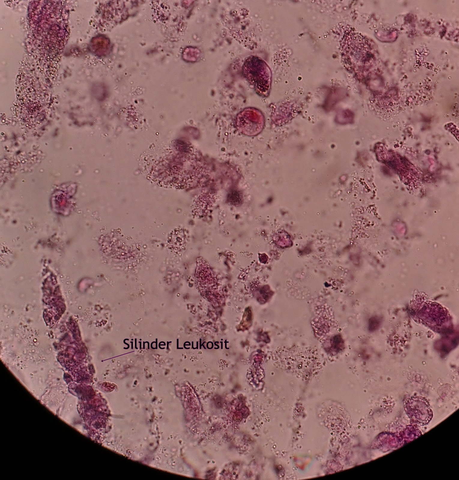 Sedimen Urine Metode Pewarnaan Stainning Analis Kesehatan