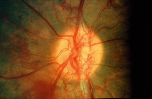 Diabetic Retinopathy Cure