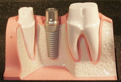 Cấy ghép răng Implant nha khoa là gì ?