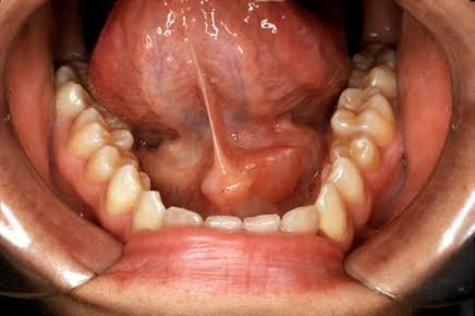 Salivary gland swelling