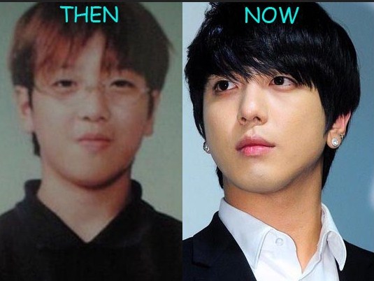 Jung Yong Hwa Sebelum dan Sesudah Operasi Hidung