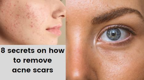 8 secrets on how to remove acne scars