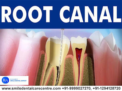 Painless Root Canal Treatment In India