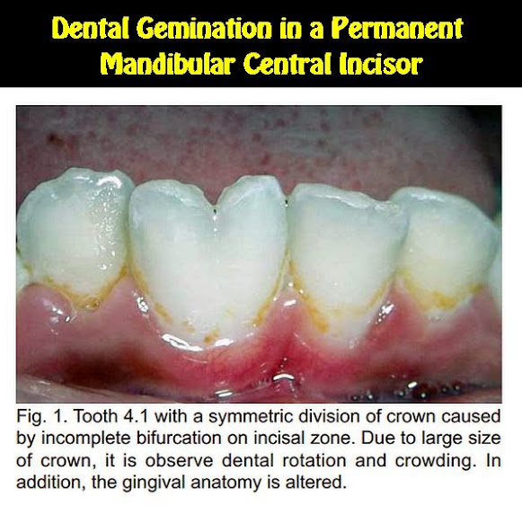 PDF: Dental Gemination in a Permanent Mandibular Central Incisor: an Uncommon Dental Anomaly