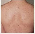 Home remedy for back acneBack Acne Home Remedy  