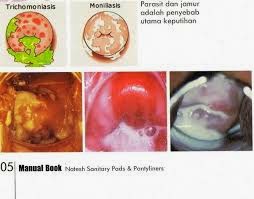 Cara Mengobati Keputihan Yang Sudah Parah