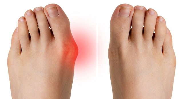 diagnosis treatments bunions