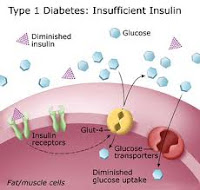 root causes type 1 diabetes