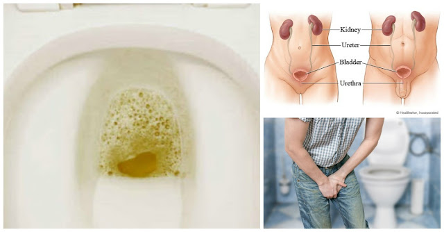 Apakah Saat Buang Air Kecil Urine Anda Berbuih ?? Hati-Hati Itu Adalah Pertanda Masalah Pada Kesehatan, Ketahui Alasannya Sebelum Menyesal !!