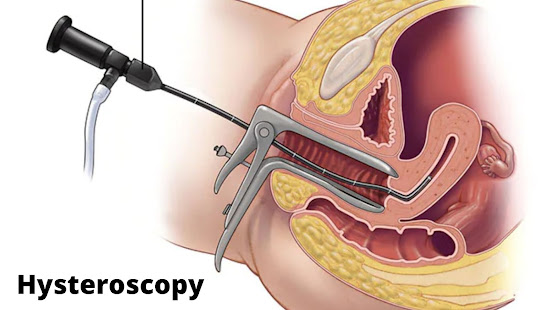 Hysteroscopy for uterine fibroid