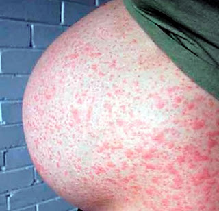 virus rubella