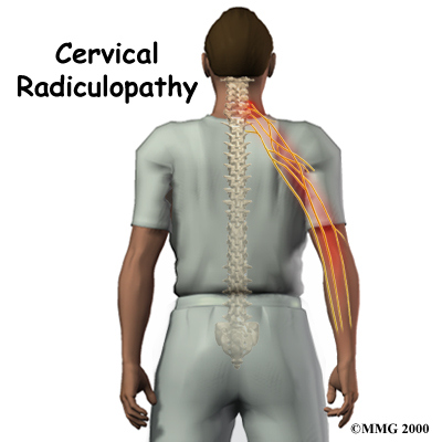 Dr Alexandre Fogaça Cervicalgia (Hérnia de disco cervical)