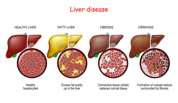 liver disease, hepatitis, cirrhosis, fatty liver, liver cancer, liver function, liver pain, liver failure, liver fluke, hepatitis d