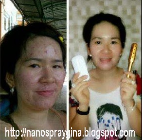 Testimoni Manfaat Nano Spray 2 dan Magic Stick MCI Bagi Kulit Wajah