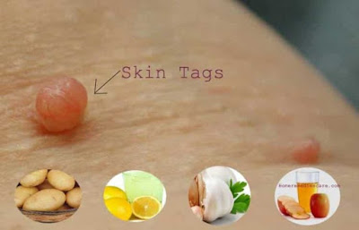 REMOVE SKIN TAGS WITHOUT PAIN