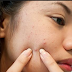 8 domestic measures to remove acne