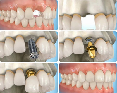 Tìm hiểu về chi phí thực hiện ghép răng implant Nha khoa