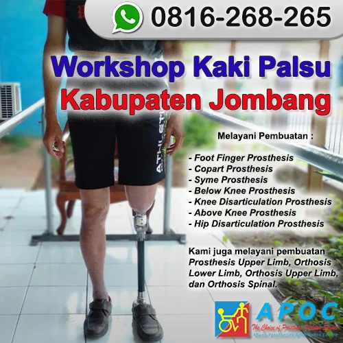 Workshop Kaki Palsu Kabupaten Jombang >> WA 0816-268-265, Kaki Palsu Endoskeletal