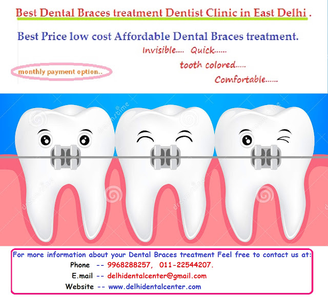 Dental Braces clinic Delhi, Dental Braces Delhi, orthodontist Delhi, Dental Braces in Delhi, Braces Dentist in Delhi, Braces Delhi, Braces Clinic in Delhi, Dental Braces Treatment in Delhi.