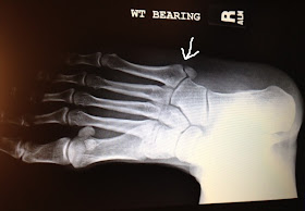  split at the arrow shows the avulsion fracture in my 5th metatarsal-4.bp.blogspot.com