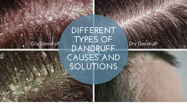 Different Types of Dandruff Causes and Solutions