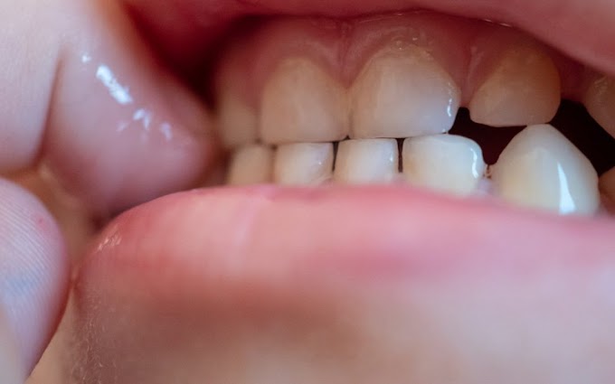 What is Bruxism During Sleep?