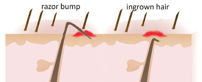 ingrown hair