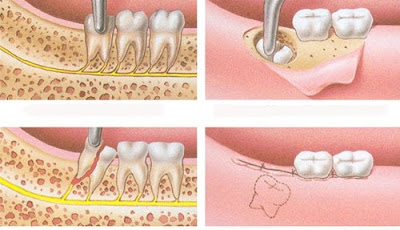  Quy trình nhổ răng khôn an toàn