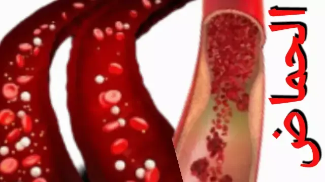 الحماض التنفسي