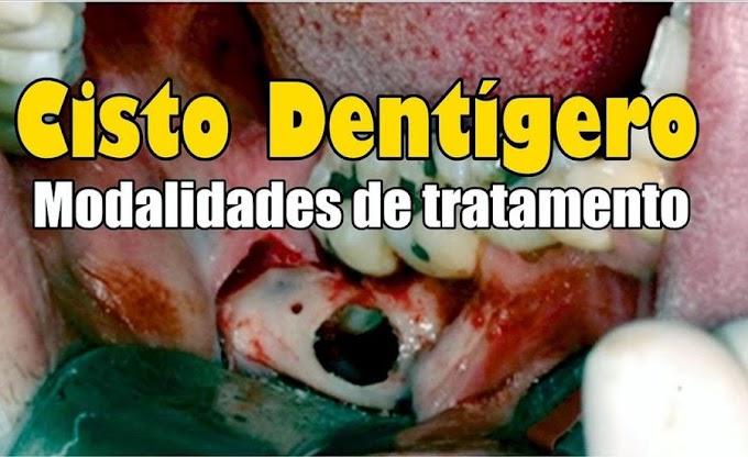 PDF: Cisto dentígero: modalidades de tratamento