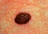 moles and skin cancer