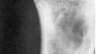  Simple bone cyst in x-ray