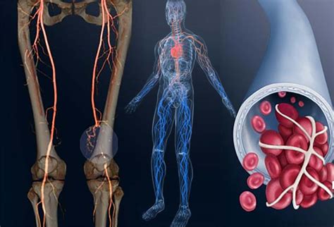 Venous Thromboembolism