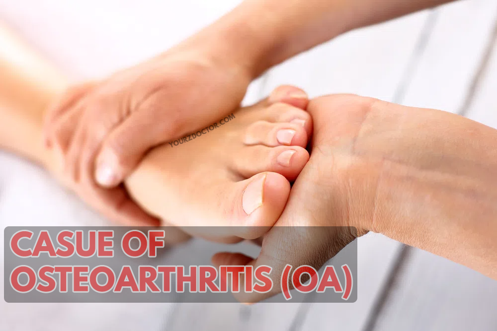 Causes of Osteoarthritis