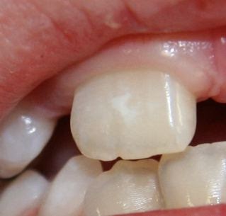 Pediatric Dentistry White Spots On Teeth Enamel Hypoplasia