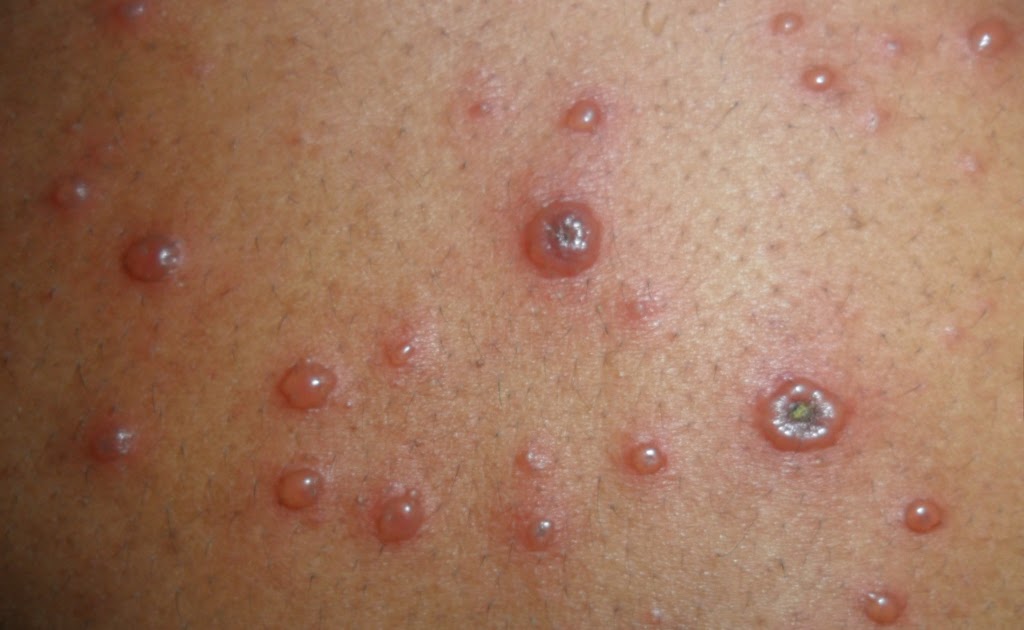 ErnieNonie: Penangan Chiken pox