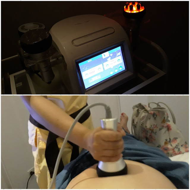 LIPO CAVITATION (tummy)