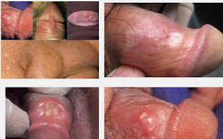 Obat Bentol Di Kemaluan Dan Gatal