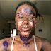 Burn survivor shows off her amazing transformation as skin heals without blemish