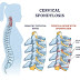 Treatment of Cervical Spondylitis