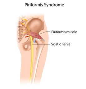 Piriformis Syndrome Lingers On